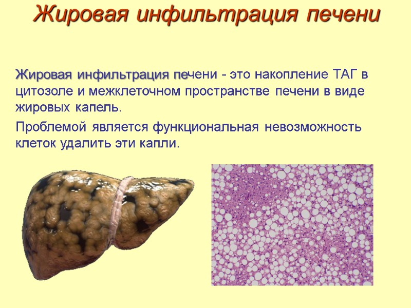 Жировая инфильтрация печени Жировая инфильтрация печени - это накопление ТАГ в цитозоле и межклеточном